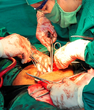 operacio donacio organos