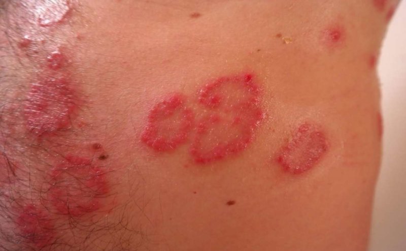 marcas de sarna en el cuerpo 800x494