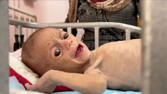 desnutricion gaza