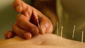acupuntura
