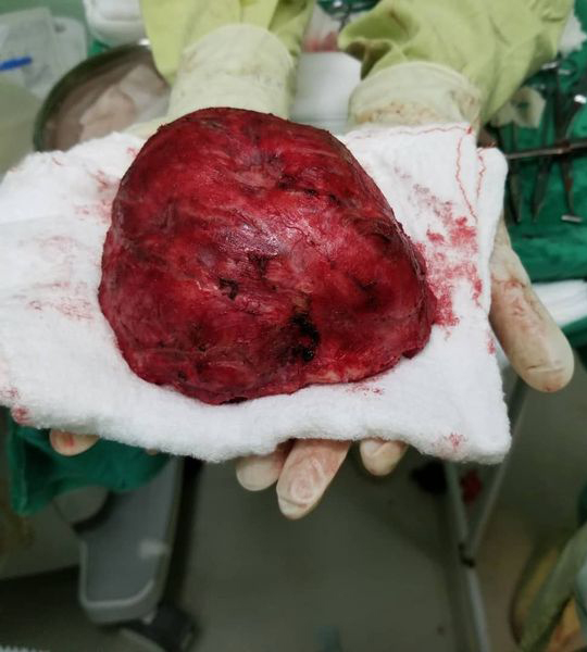 operacion tumor cerebro2