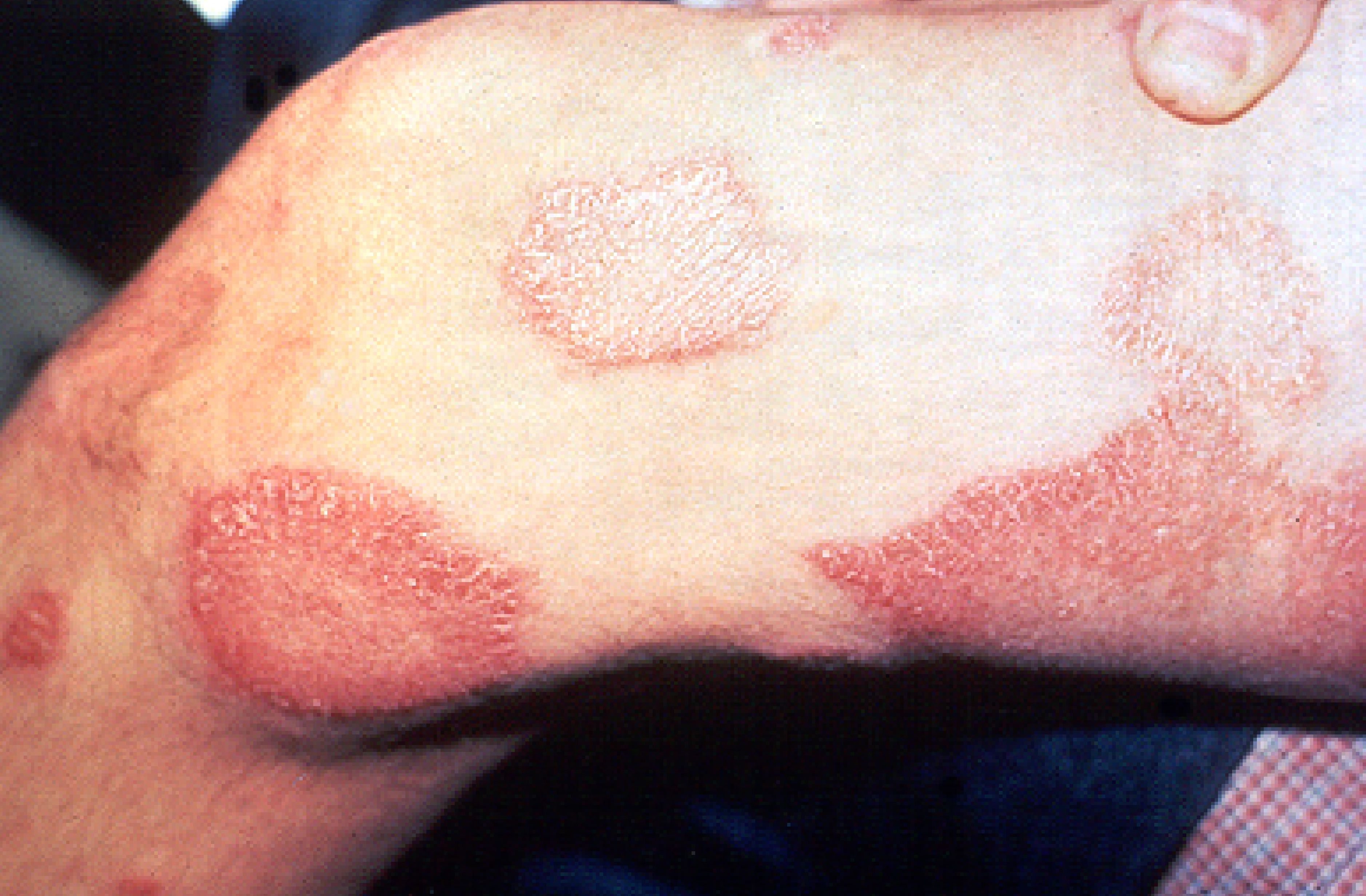 Leprosy thigh demarcated cutaneous lesions