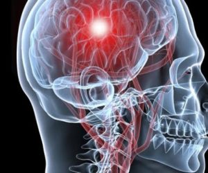 cerebro-isquemia-300x250