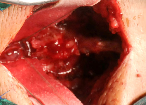 31 operación de vertebra