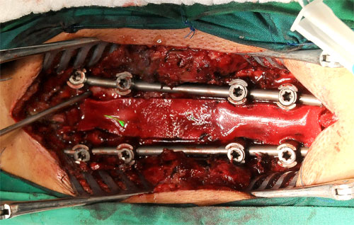 63 operación de vertebra