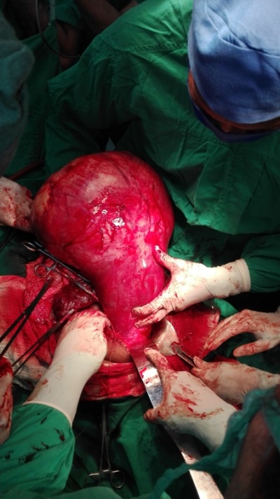 fibroma operacion2
