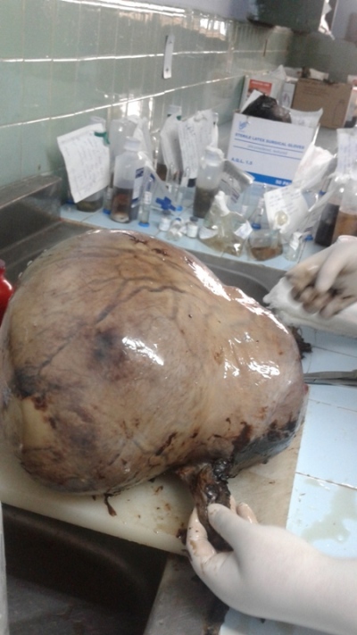 fibroma operacion3