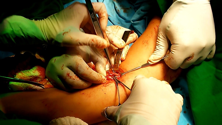 fistula operacion
